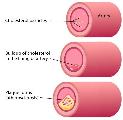 Cao mỡ trong máu / Rối loạn mỡ trong máu (High Cholesterol)