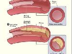 Lượng Cholesterol của quý vị có quá cao không?